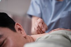 西醫也能針灸？　衛福部：完訓即可、多為自費負擔