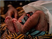 世衛組織：M痘疫情仍為國際公衛緊急事件